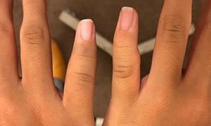 突き指で来院 指の骨折 ヒビ 治療ケース 応急対応含む 豊田市 上郷接骨院