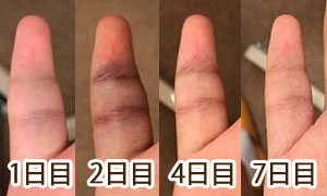 突き指で来院 指の骨折 ヒビ 治療ケース 応急対応含む 豊田市 上郷接骨院
